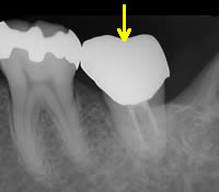移植した歯の周りにしっかりとした骨ができています