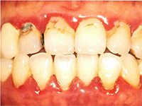 歯周病の治療前
