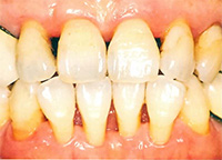 歯周病の治療後