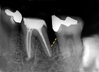歯周組織再生治療前