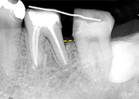歯周組織再生治療後