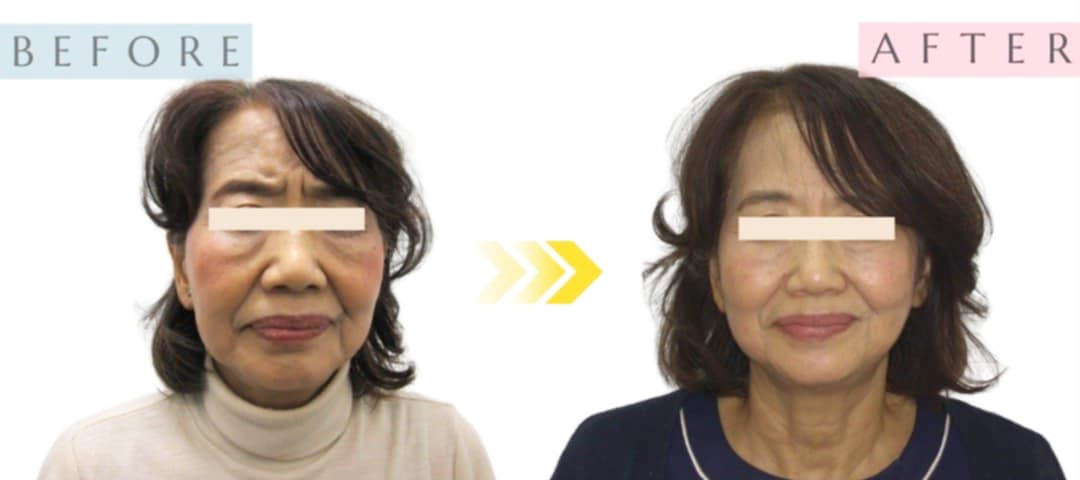 BEFORE AFTER